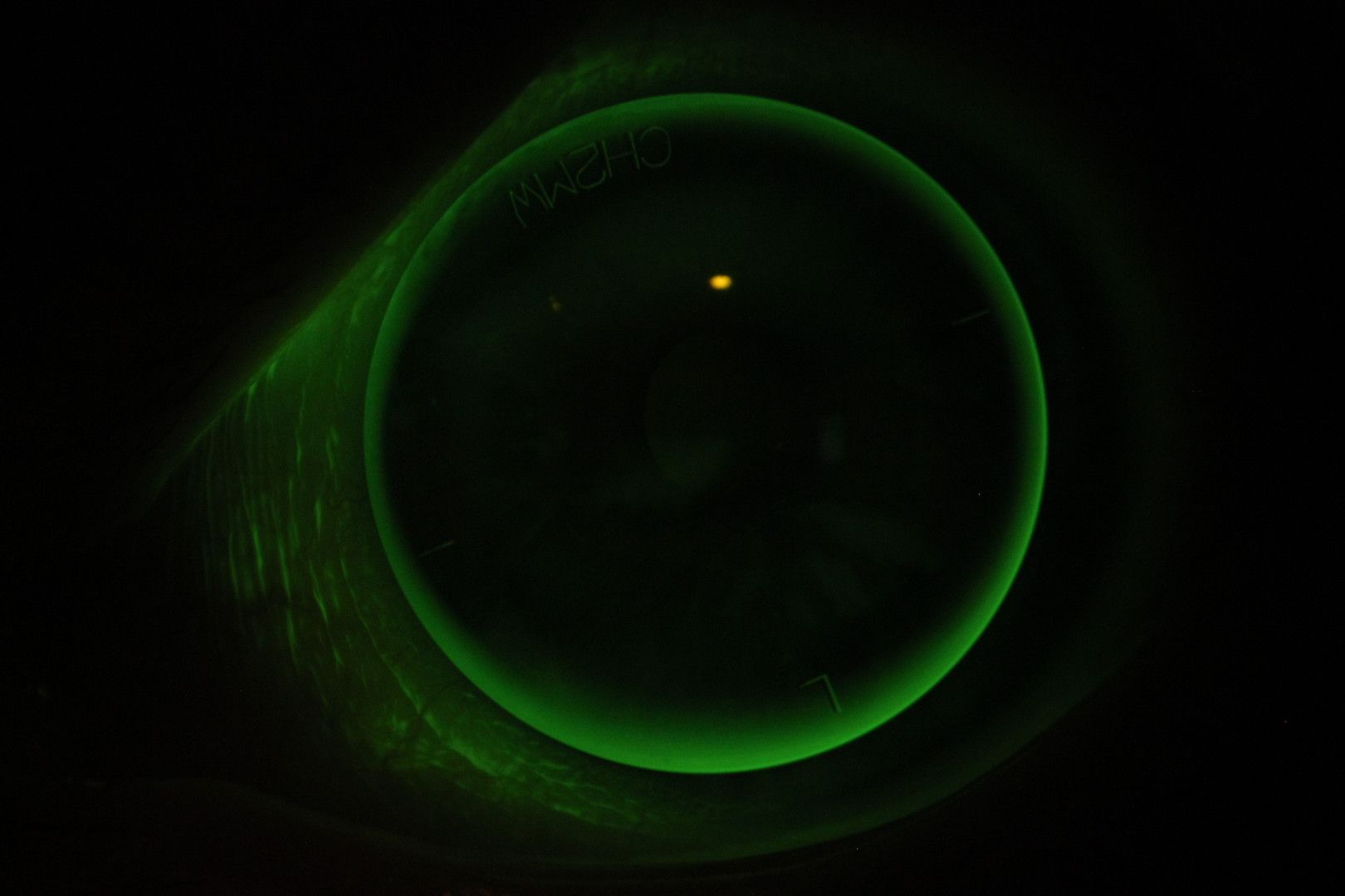 EyeSpace® Bespoke lens on an eye with NaFl staining