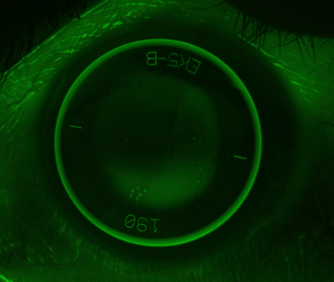 An EyeSpace® Ectasia lens on the eye with NaFl staining.