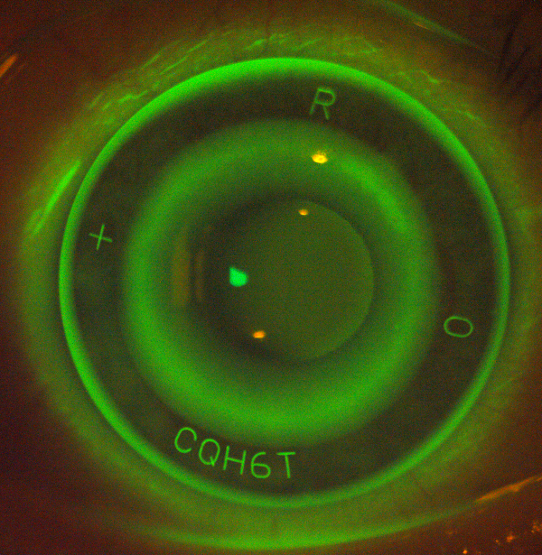 EyeSpace® Forge® Ortho-K lens on an eye illuminated green with NaFl