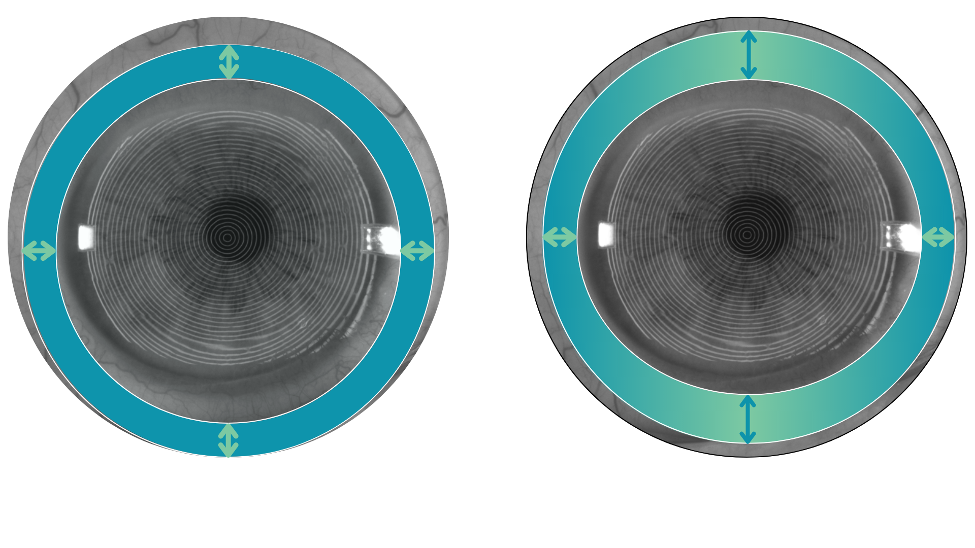 Comparison of standard and ovate diameters, demonstrating an oval landing zone over an eye with a Placido disc pattern, compared with a circular-diameter landing zone.