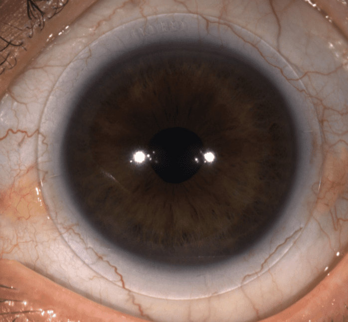 An EyeSpace® Scleral lens on the eye under white light